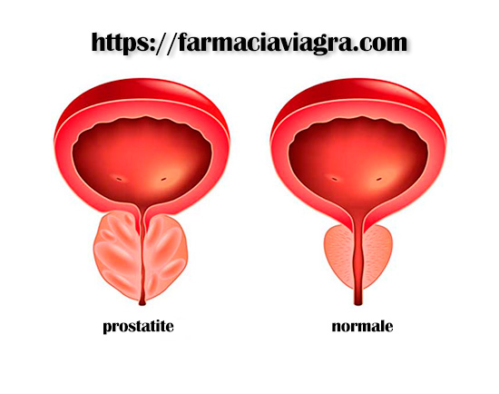 Prostatite e potenza
